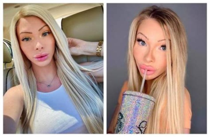 Queen Manica Money Before Surgery | Plastic Surgery Before And After Photos