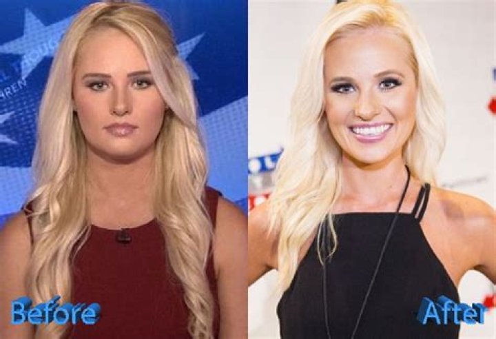Tomi Lahren Nose Job Before And After Photos, Botox Plastic Surgery